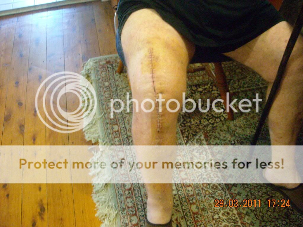 Tok Tok place Images from my knee replacement